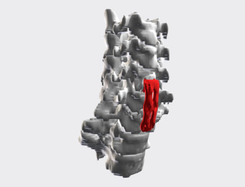A step beyond 2D imaging: How 3D printing is transforming personal injury cases
